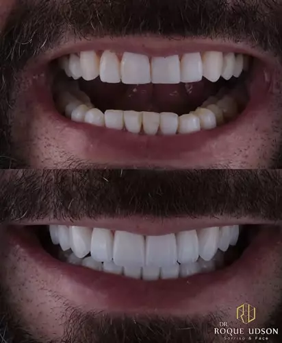 Qual a Diferença Entre Facetas de Porcelana e Lentes de Contato Dental