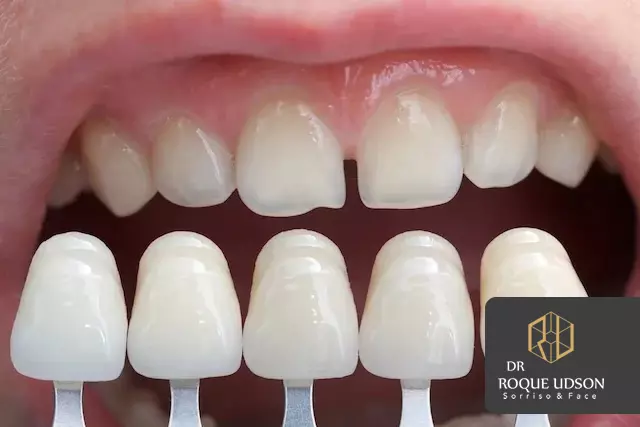 Facetas Dentárias: Revolucionando a Estética Oral